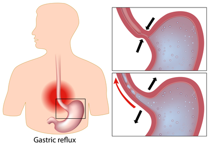 acid reflux